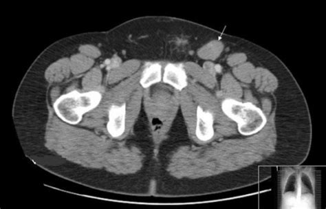 Figure 2inguinal Lymph Node Metastases From A Testicular Seminoma A