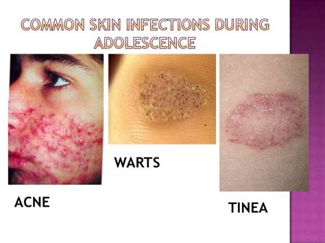 Common Skin Diseases During Adolescence