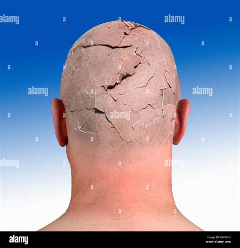 Person With Cracked Head Illustration Stock Photo Alamy