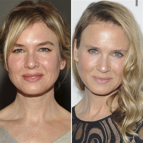 Renee Zellweger Before And After Plastic Surgery