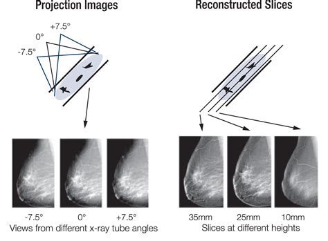 [pdf] Fundamentals Of Breast Tomosynthesis Improving The Performance Of Mammography Semantic