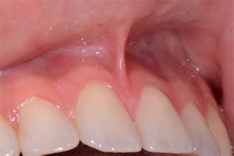 Frenectomy Kentucky Periodontics And Implant Dentistry