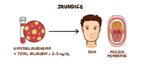 Approach To Jaundice Conjugated Hyperbilirubinemia Clinical Sciences Osmosis Video Library