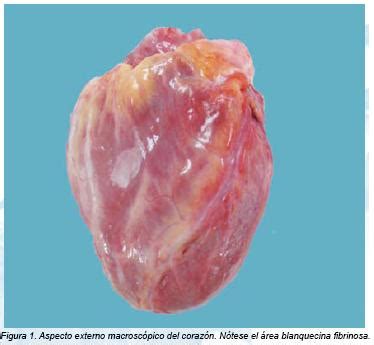 Anguita snchez servicio de cardiologa. Miocarditis linfocítica por tripanosoma: reporte de un caso