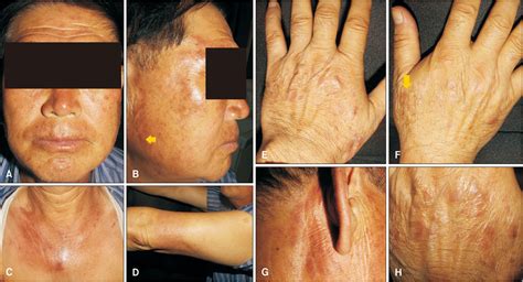 Pdf A Case Report Of Pirfenidone Induced Lichenoid Drug Eruption In A