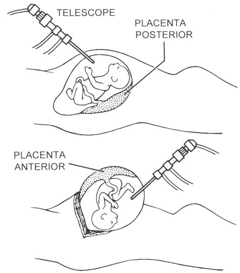 Techniques Of Fetal Intervention