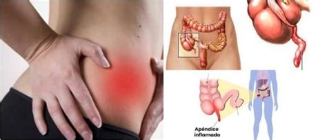 Apendicitis Síntomas Causas Factores De Riesgo Diagnóstico y Tratamiento Arriba Salud