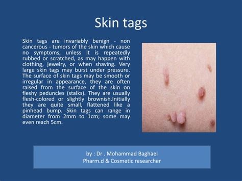 A Brief Review Skin Cysts Lumps And Bumps