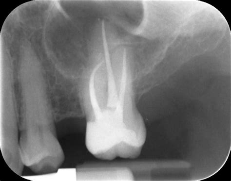 Dental Care Lichtaart Endodontie Wortelkanaalbehandeling