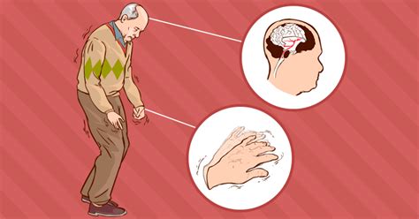 Primeiros Sintomas De Parkinson E O Que Fazer Tua Saúde