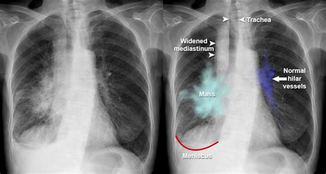 Chest X Ray Lung Cancer Hilar Mass And Effusion