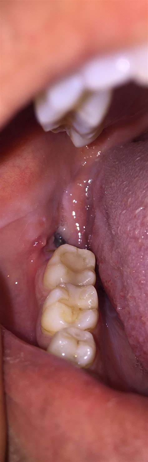 Dry Socket After Wisdom Tooth Extraction Or Just Normal Nerve
