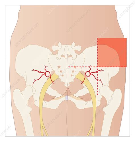 Dorsogluteal Injection Site Artwork Stock Image C0084830 Science Photo Library