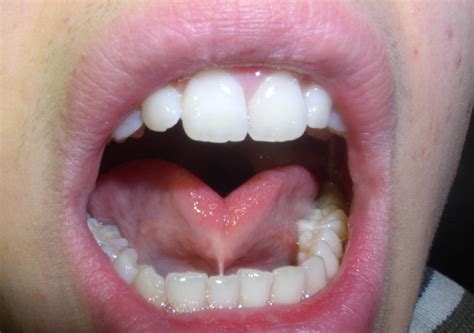 Bệnh Cứng Lưỡi Ankyloglossia Nguyên Nhân Triệu Chứng Vinmec