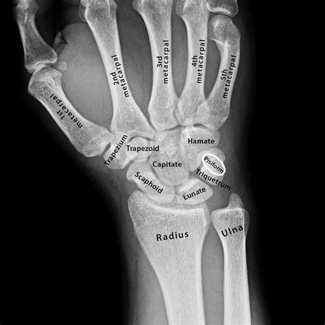 Carpels Lateral Labeled Radiology Emergency Medicine Wrist Anatomy My