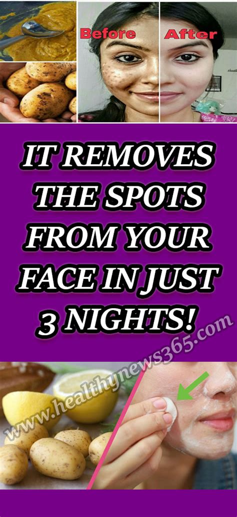 It Removes The Spots From Your Face In Just 3 Nights With Images