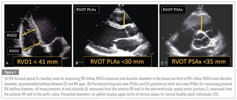 Echocardiographic Criteria For Athlete´s Heart With Cut Off Parameters