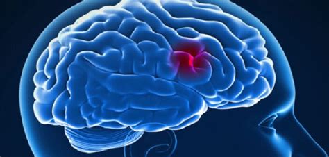 Definition of stroke it in the idioms dictionary. 24 timmar före en stroke varnar kroppen dig — dessa dolda ...