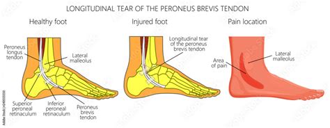 Vector Illustration Of Peroneal Tendon Injuries Longitudinal Tear Of The Peroneus Brevis Tendon