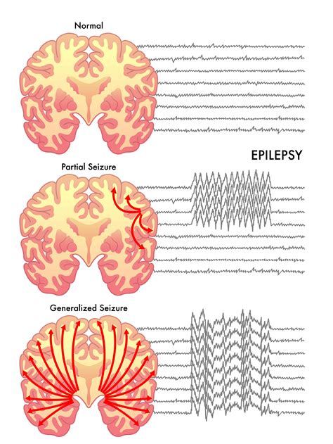 Can Essential Oils Help With Seizures And Epilepsy Essential Oil Benefits
