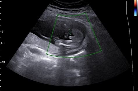 最新 24 Weeks Pregnant Ultrasound 3d 214767 Can You Get A 3d Ultrasound