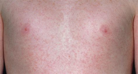 Rubella German Measles In Children Ages One To Five Babycentre