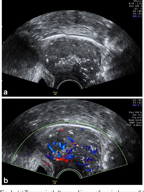 Figure 1 From Three Dimensional Transvaginal Tomographic Ultrasound