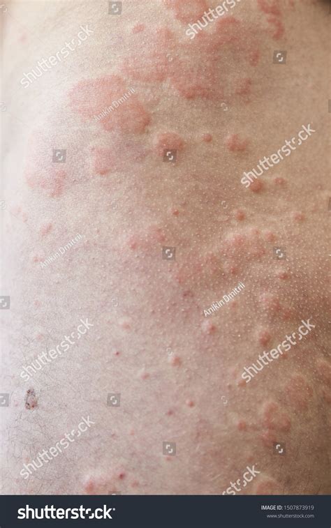 Skin Imperfection Skin Allergy Urticaria Disease Stock Photo 1507873919