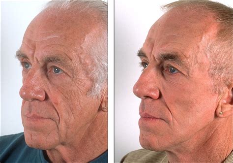 Chemical Peel For Men Chemical Peel Before And After Pictures Denver