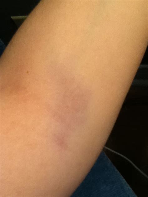 Bruises On Bloodtest Arm Flickr Photo Sharing