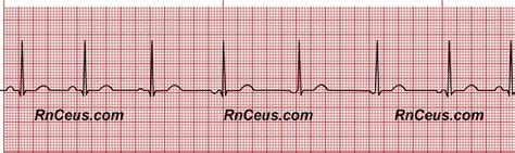 Wandering Atrial Pacemaker