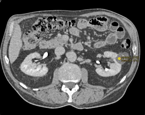 Bosniak 2f Cyst Left Kidney Kidney Case Studies Ctisus Ct Scanning