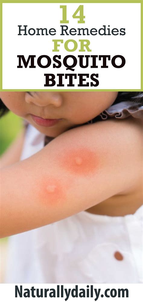 Top 14 Home Remedies For Mosquito Bites Remedies For Mosquito Bites