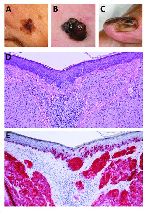 Clinical And Histological Presentation Of Melanoma A Superficial Download Scientific
