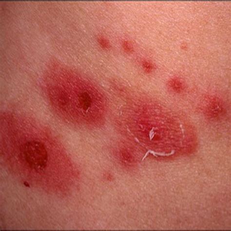 What Is The Illness Shingles