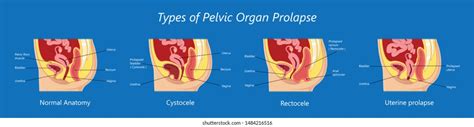 Pelvic Floor Prolapse Type Uterine Uterus Stock Vektorgrafik
