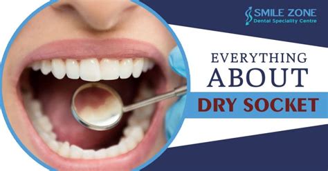 Everything You Must Know About Dry Socket