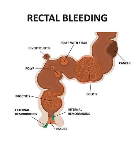 When the rectal veins and surrounding tissues become inflamed, they often hemorrhoids and colorectal cancer have often been mistaken for each other and misdiagnosed, so don't take any chances. Blood in stool: 15 Reasons for Cause of Blood in Stool