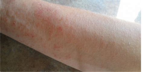 Do You Know Yeast Overgrowth Can Cause This Itchy Rash