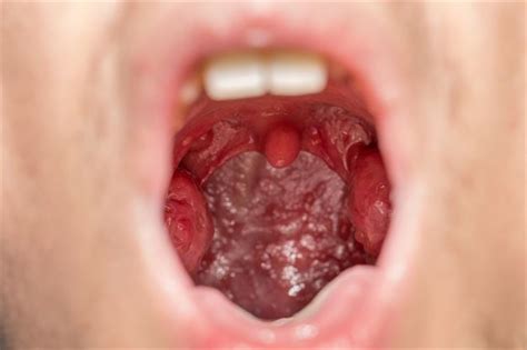 See Do You Know What Infected Tonsils Look Like Health24