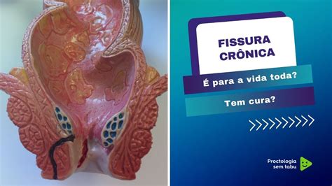 Babosa Para Fissura Retal