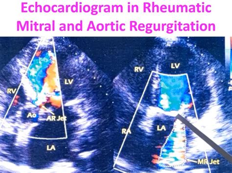 Echocardiogram In Rheumatic Mitral And Aortic Regurgitation All About