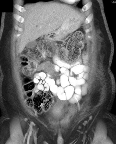 Mesenteric Cyst Gastrointestinal Case Studies Ctisus Ct Scanning