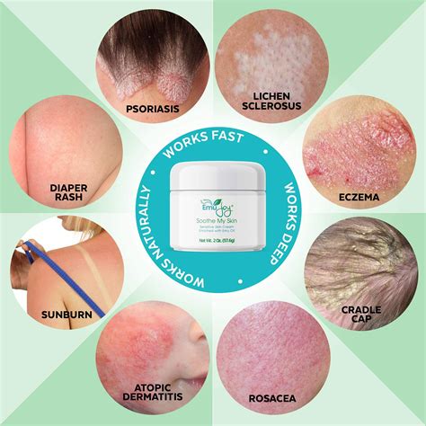 Banish My Rash Cream for Psoriasis Eczema Rosacea Dermatitis. Effective