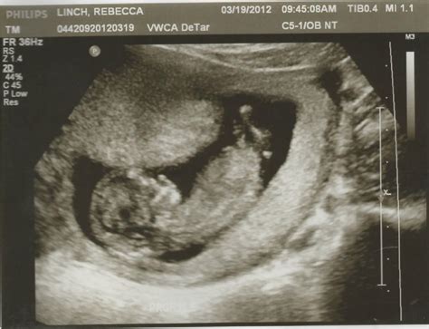 Little Baby Linch 12 Week Picture Plus Ultrasound