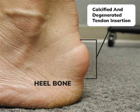 Achilles Tendinitis Treatment Heel Pain Symptoms Causes