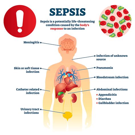 Sepsis In Elderly Adults What To Know