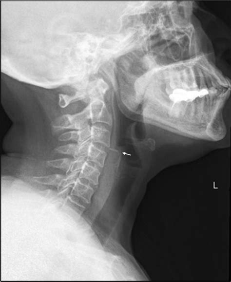 Cureus Hypopharyngeal Perforation Following Foreign Body Ingestion A