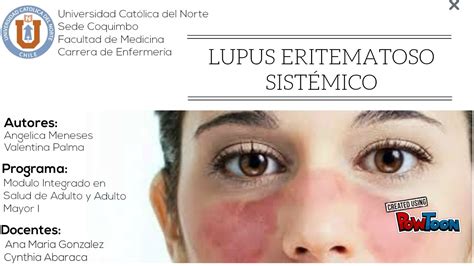 Guía Clínica Lupus Eritematoso Sistémico Youtube