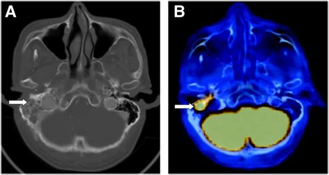 Role Of 18f Fdg Petct In Management Of High Grade Salivary Gland